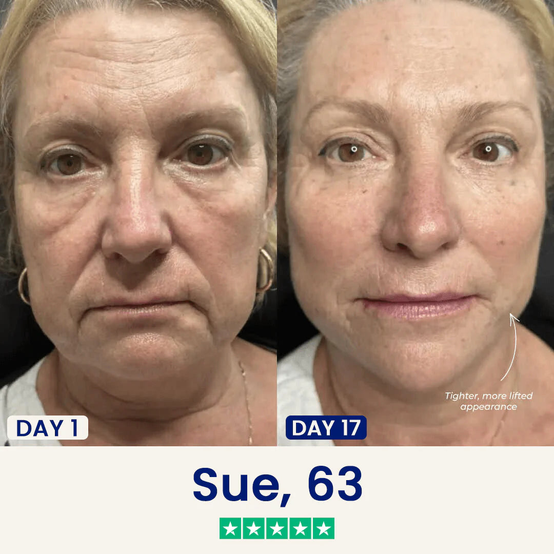 vLift Pro Series Jawline Device