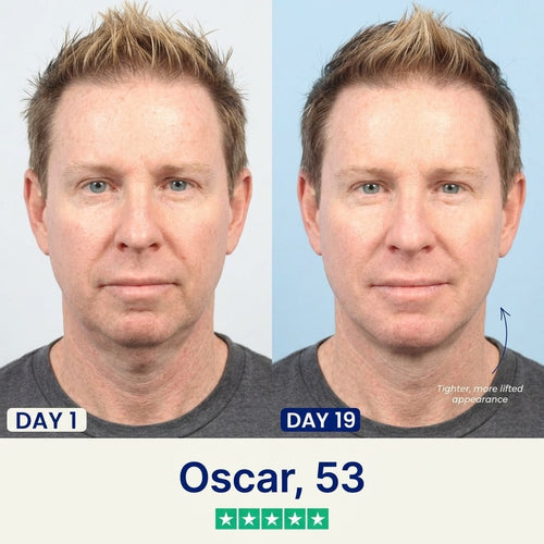 vLift Jawline Sculptor