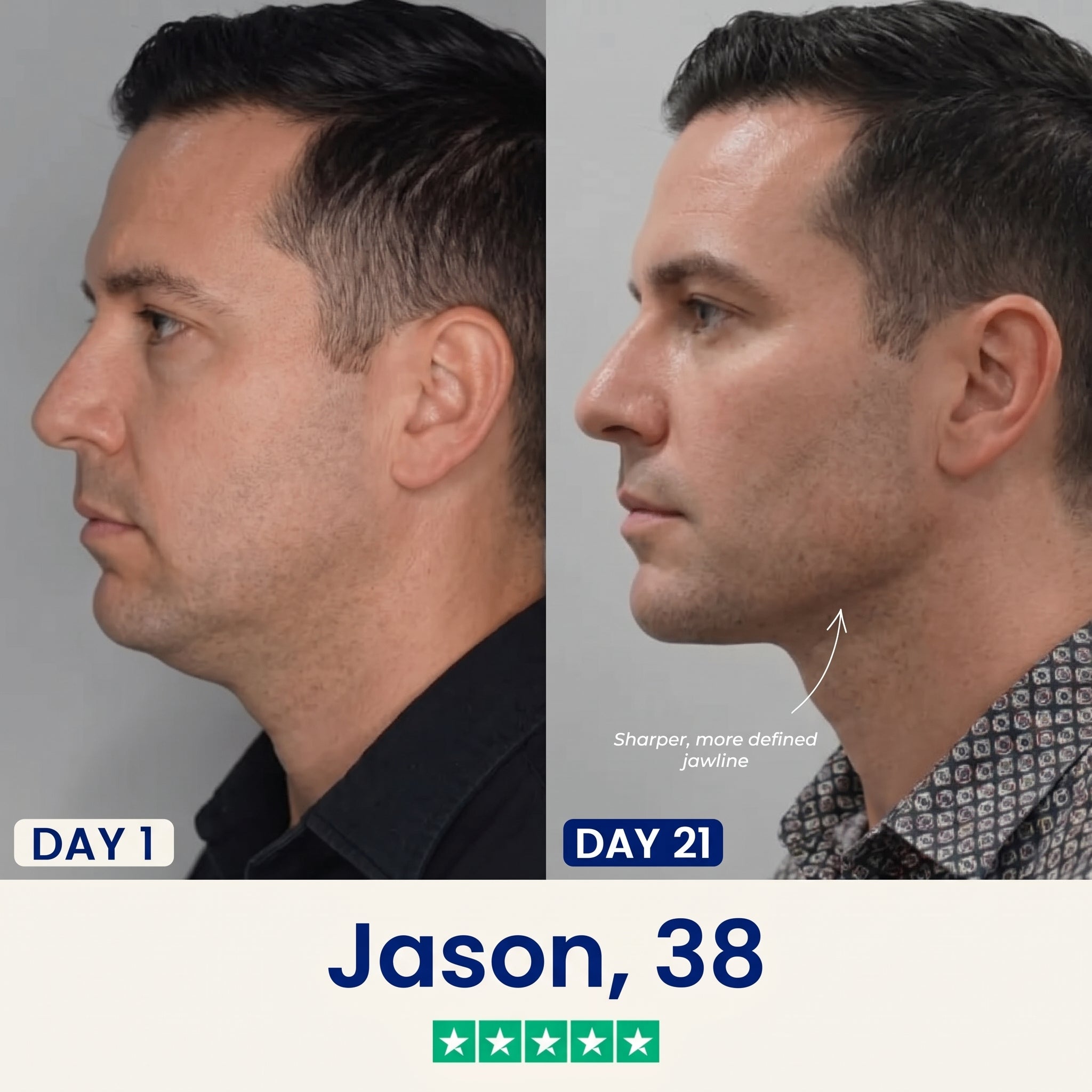 vLift Jawline Sculptor